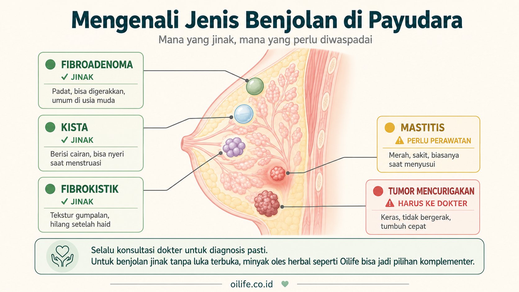Diagram jenis benjolan di payudara: fibroadenoma, kista, fibrokistik, mastitis, dan tumor yang perlu diwaspadai